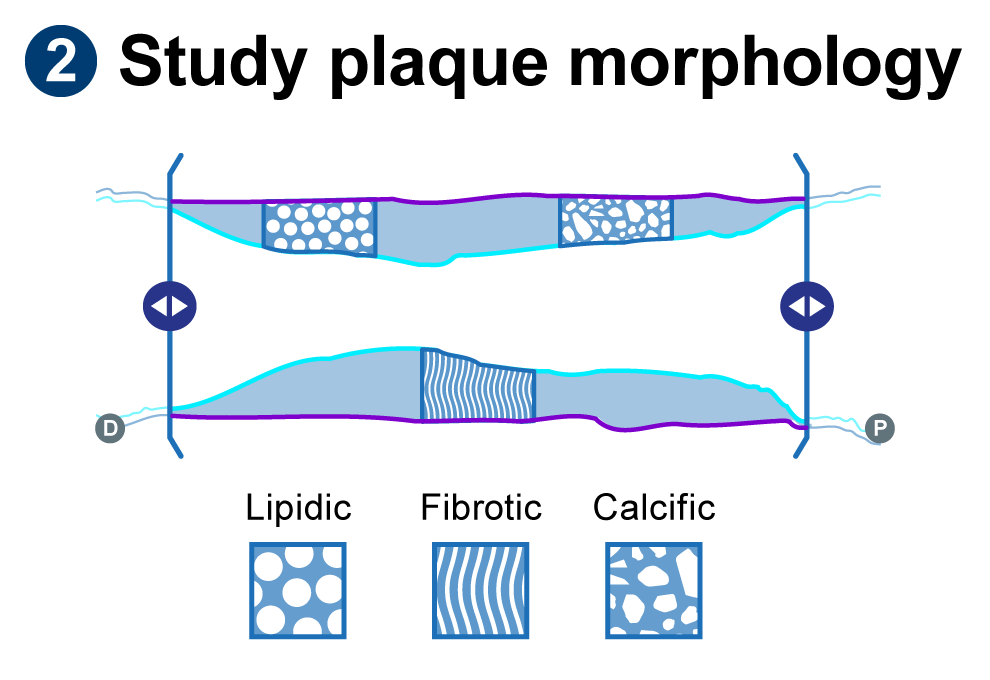 Learn how to IVUS with this simple workflow - Boston Scientific