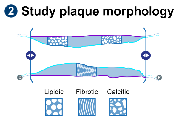 Learn how to IVUS with this simple workflow - Boston Scientific