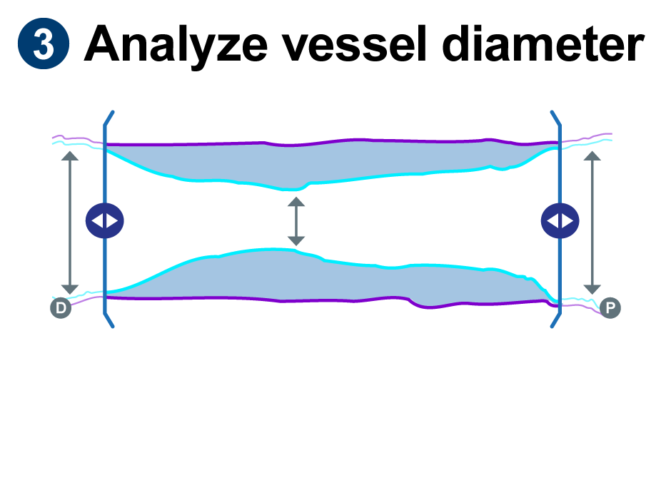 Illustration showing the sideways angle of a lesion and how to gather distal, stenosis and proximal measurements