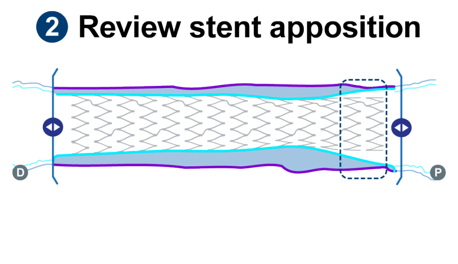 Learn how to IVUS with this simple workflow - Boston Scientific