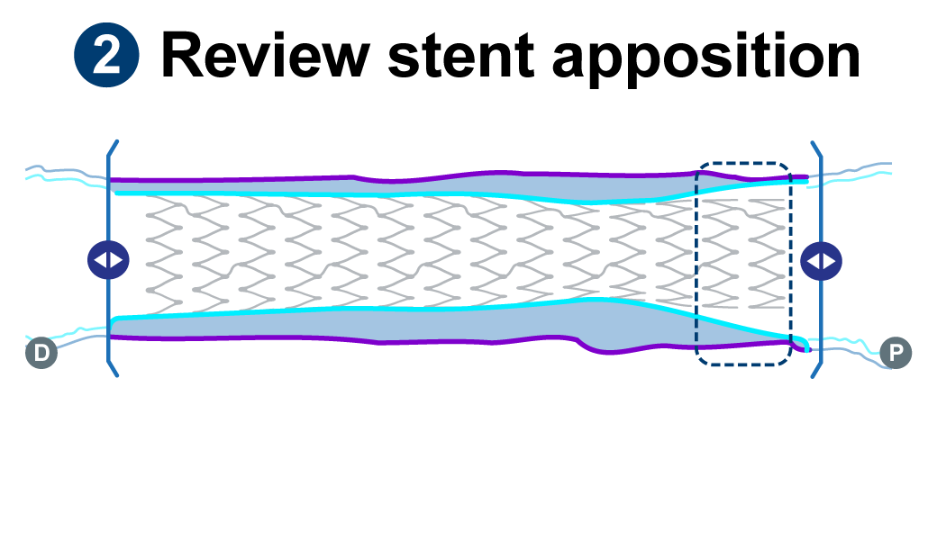 Top graphic is a lesion that is apposed and the lower graphic shows a malapposed lesion.