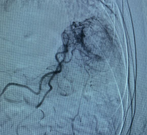 Scan of vein before placement of coil.