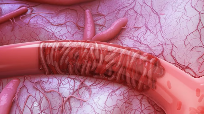 Animated thumbnail of the Embold Coils