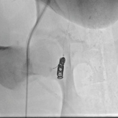 Embold Fibered Coil shown in right internal femoral artery