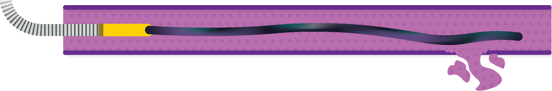 Obsidio Conformable Embolic Distal delivery.