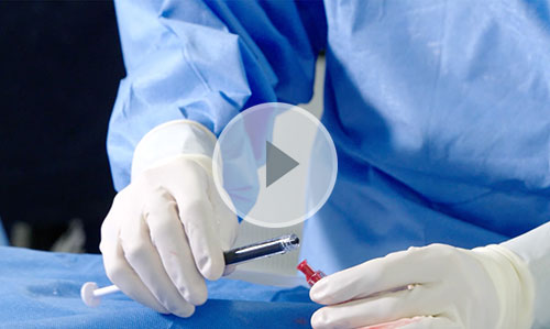 Gloved hands administering Obsidio Conformable Embolic.