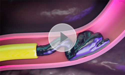 Obsidio Conformable Embolic animation.