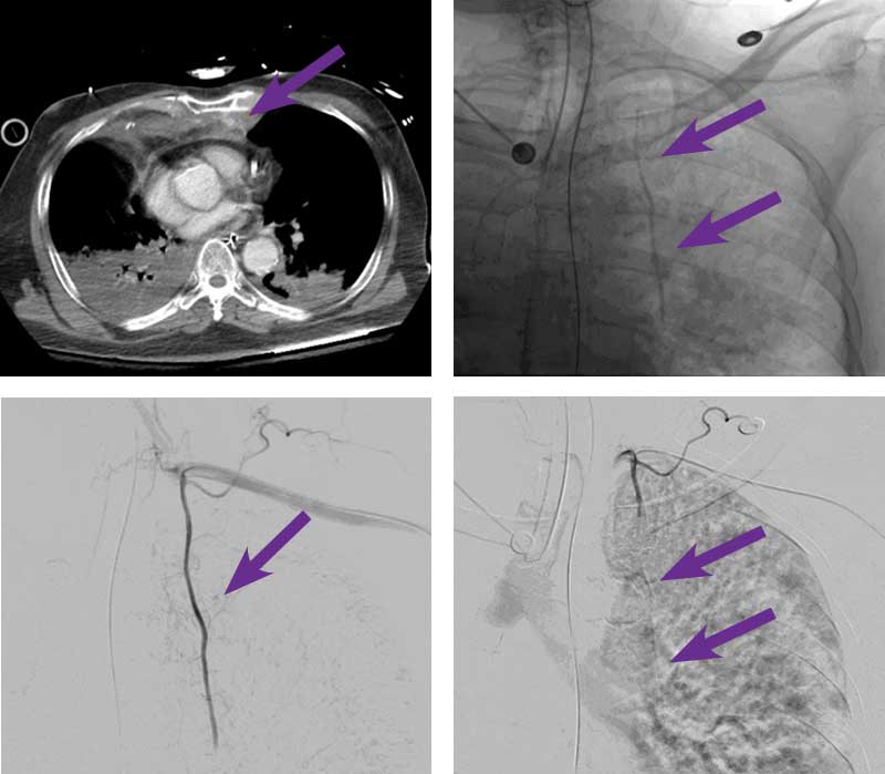Scan images from Obsidio internal mammary artery embolization case.