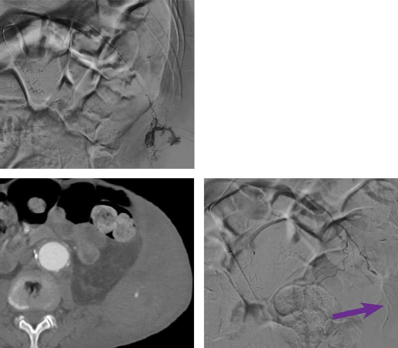 Scan images from Obsidio lumbar artery embolization case.
