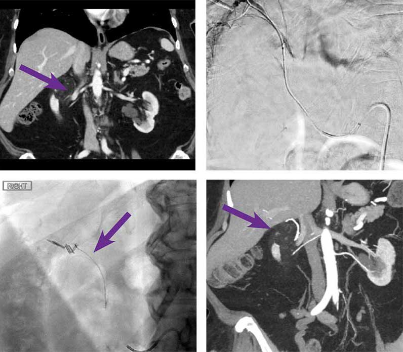 Scan images from upper pole angiomyolipoma (AML) embolization Obsidio case.