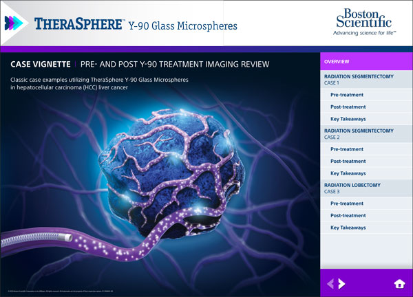PDF TheraSphere Imaging Case Vignette