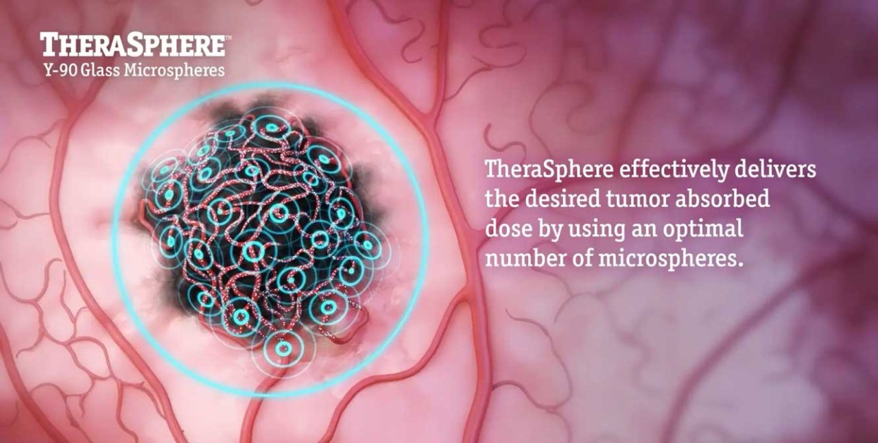 image of microspheres on tumor in body illustrating delivery of dose.