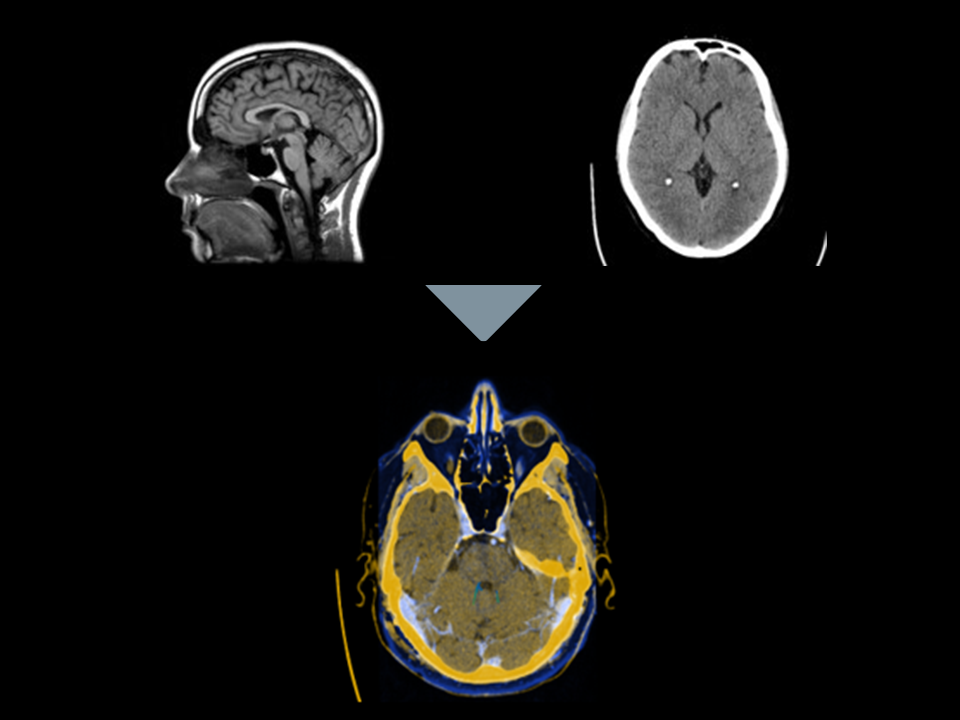 MRI and CT scans align with Brainlab Image Fusion.