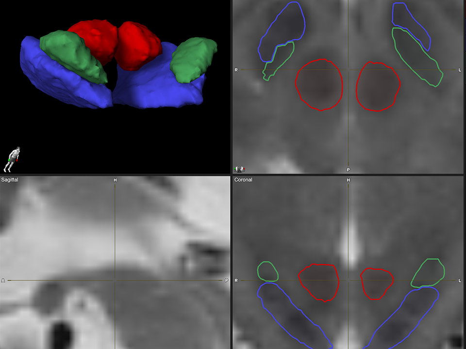 Anatomical mapping in Neural Navigator 4 software using Brainlab elements.