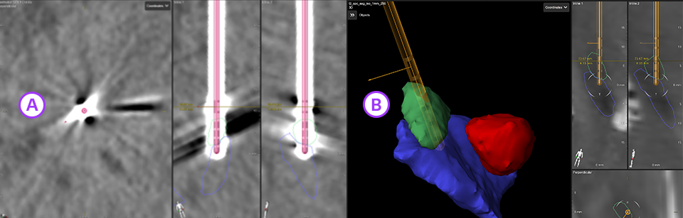 Lead localization shown on CT and in Neural Navigator 4 software with Brainlab elements.