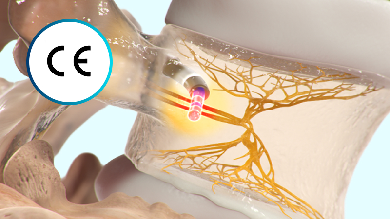 Illustration of spinal nerve area with CE mark and treatment probe emitting light.