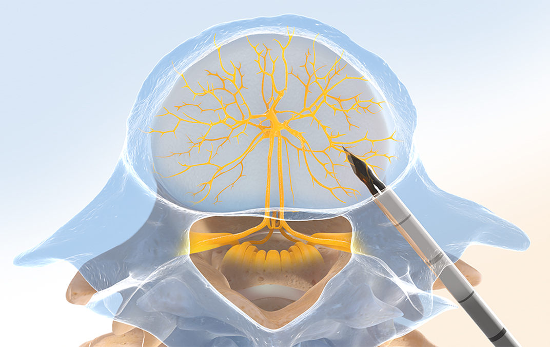 Probe inserted into vertebral body near nerve branches in step one of Intracept procedure.