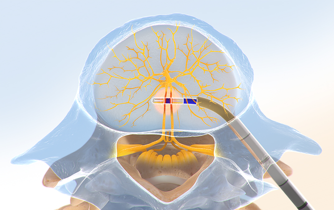Probe delivering targeted energy to basivertebral nerve inside vertebral body.