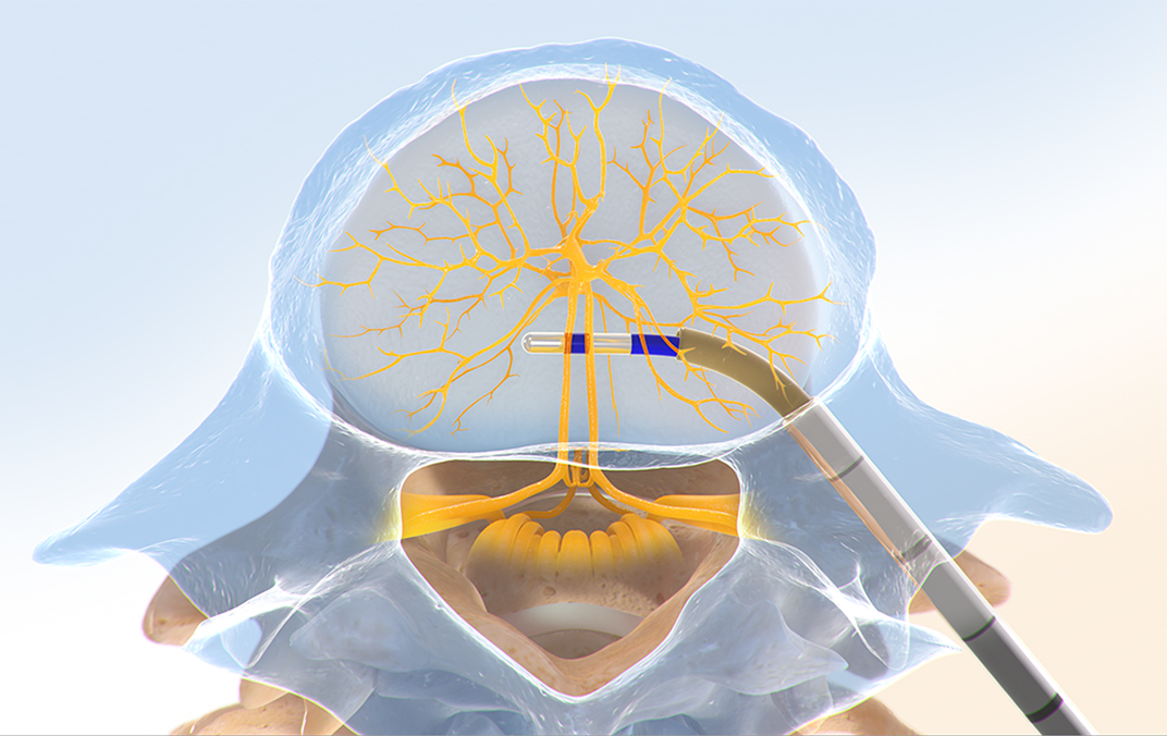 Probe fully positioned with blue treatment tip near vertebral nerve center.