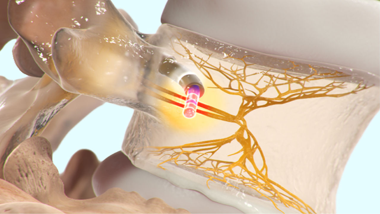 Medical illustration of probe applying energy to spinal nerve area.