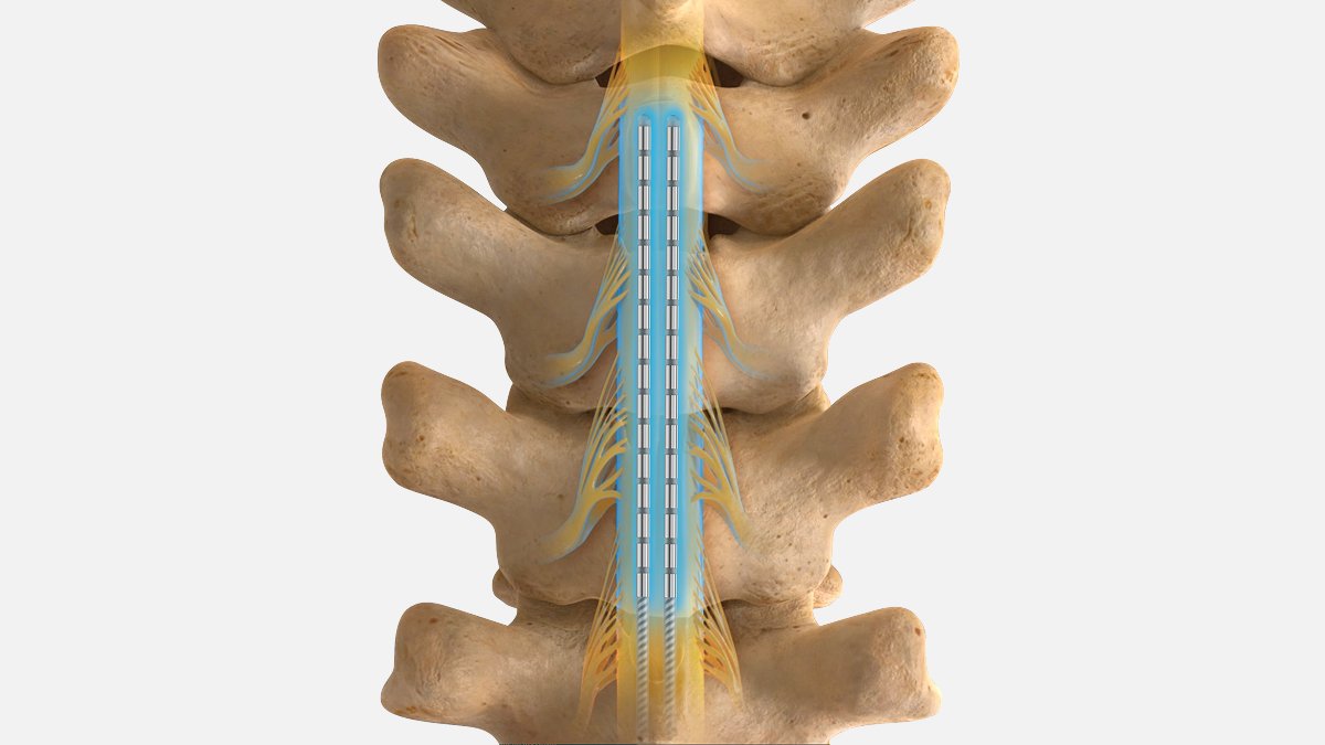 Infinion pro leads within spine.