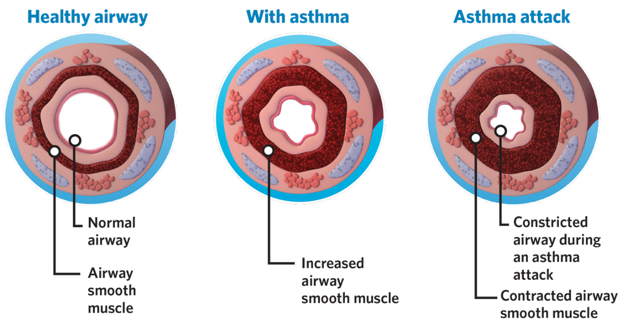 Asthma and Airways