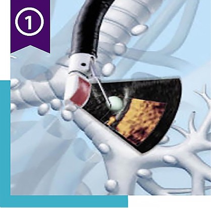 Endobronchial ultrasound illustration, with ribbon icon and number 1