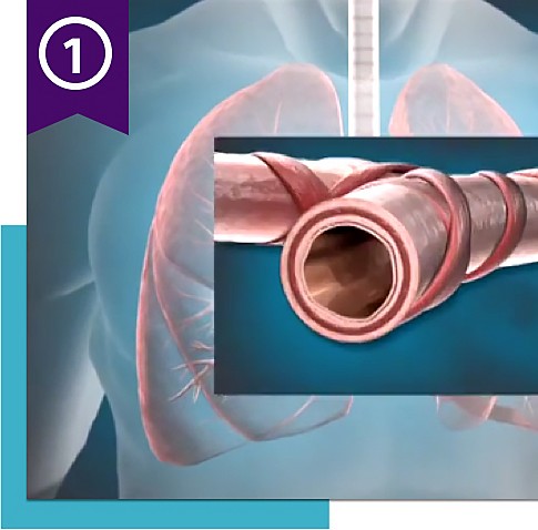 Illustration of lungs and airway, with ribbon icon and number 1