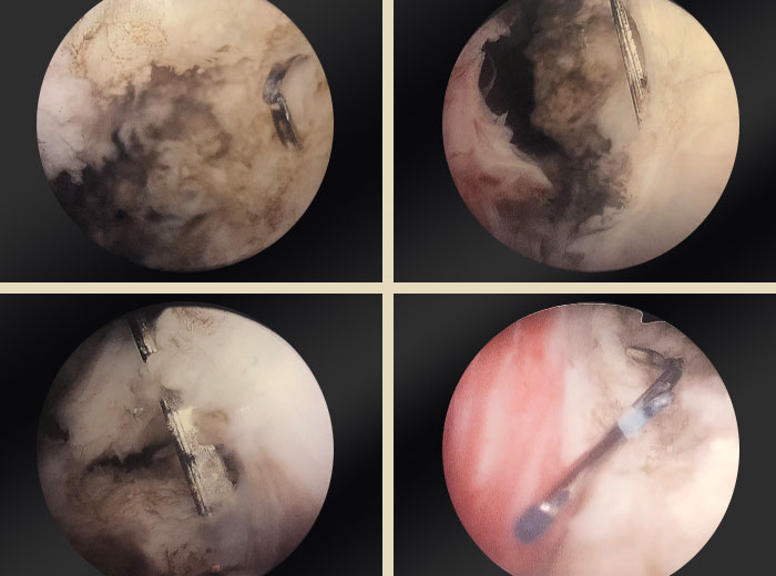 4 individual shots of an OR camera zoomed into prostate.