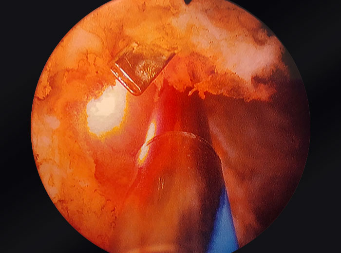 OR camera zoomed into prostate.