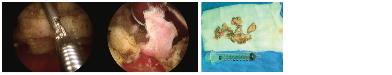 2 scope images, and a photograph of the excess material. Identifies the removal of excess.