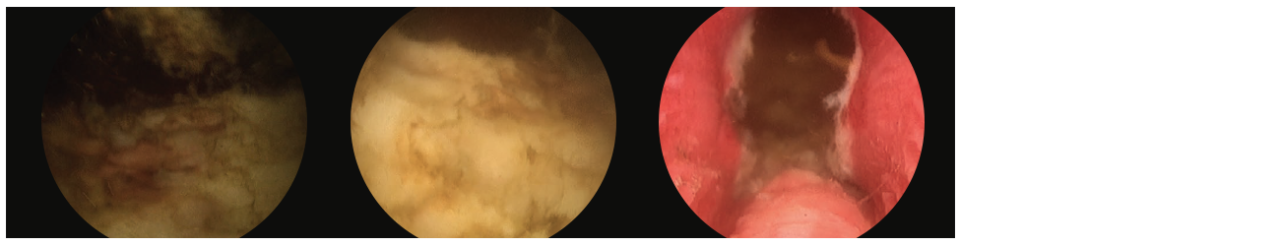 Additional 3 scope images. Identifying verumontanum. 