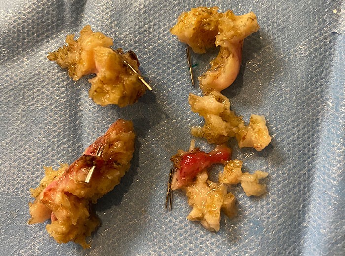Tissue extracted from a Urolift procedure. 