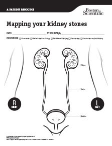Mapping Your Kidney Stone Thumbnail