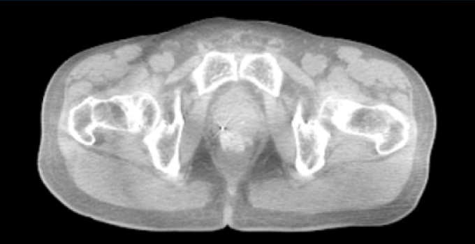 kV Cone-beam Computed Tomography image (last fraction).