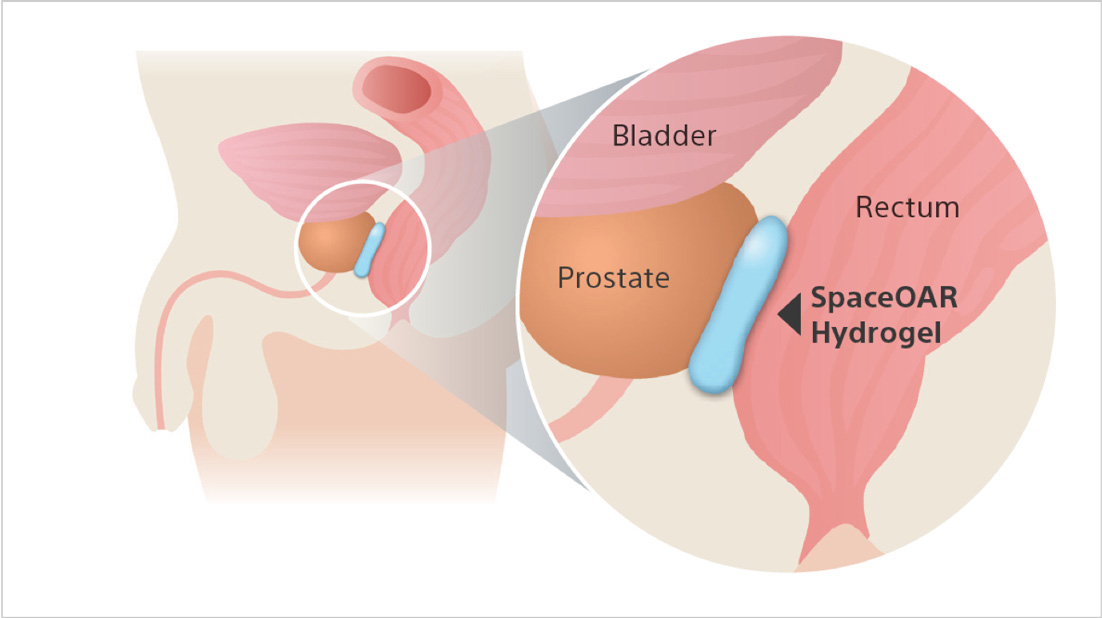 Visualization of the proximity of the prostate and rectum showing where SpaceOAR is placed  