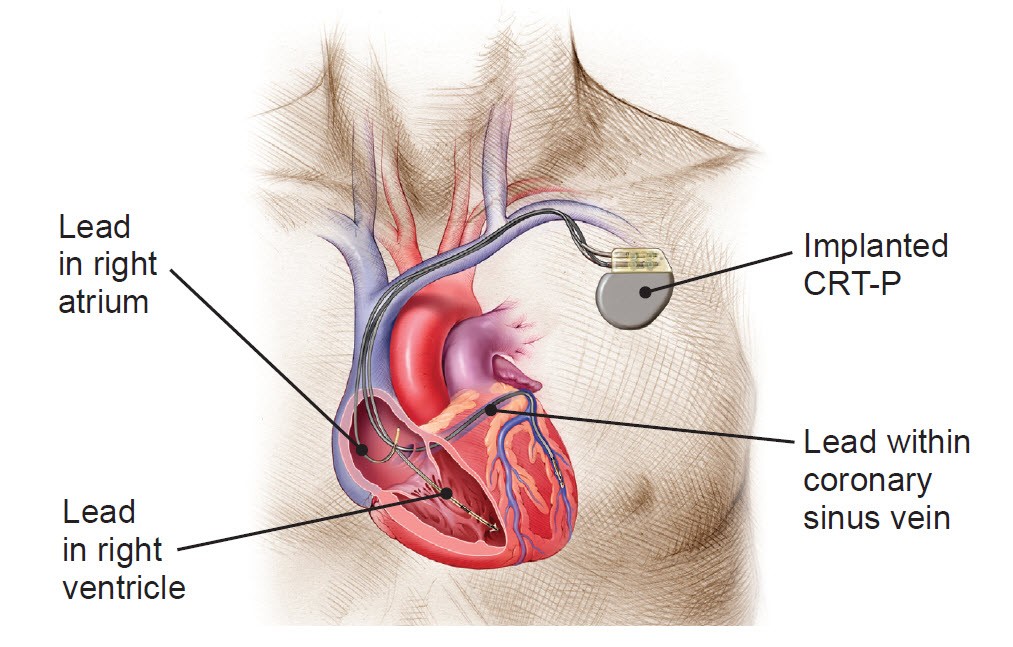 human heart image of implemented CRT-P device