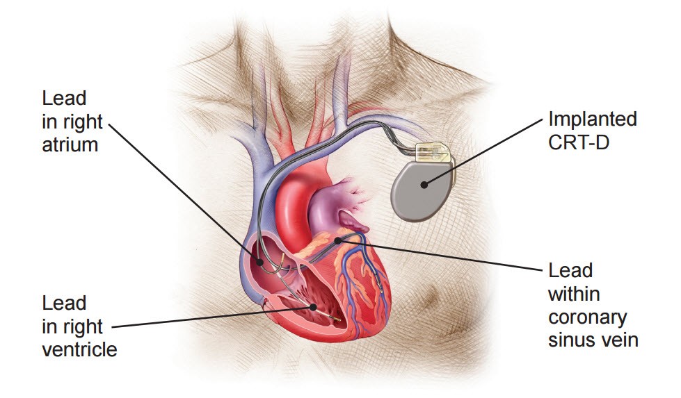 human heart image of implemented CRT-D device