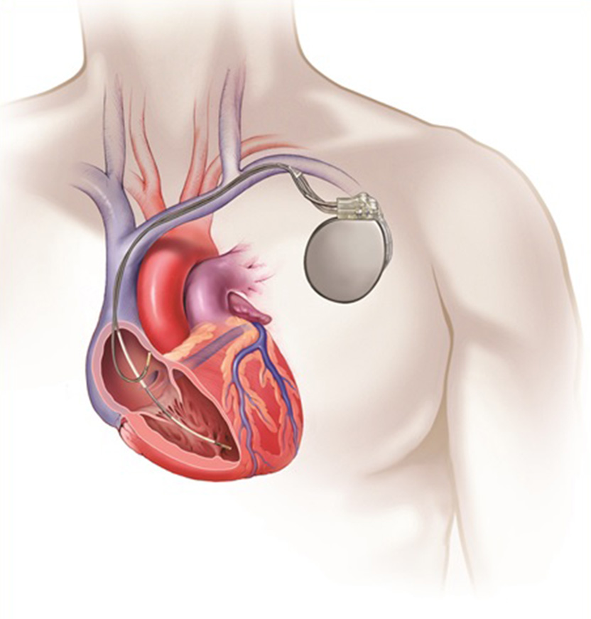 Illustration of chest with heart showing implanted ICD