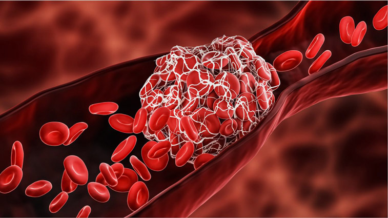Visualization of a blood clot