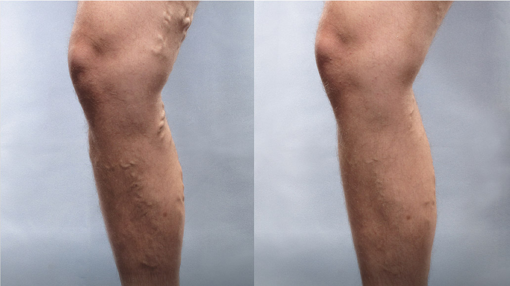 Side by side of two legs before and after Varithena treatment