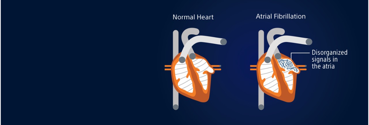 A graphic of two hearts visualization a normal heart and a heart that has atrial fibrillation.