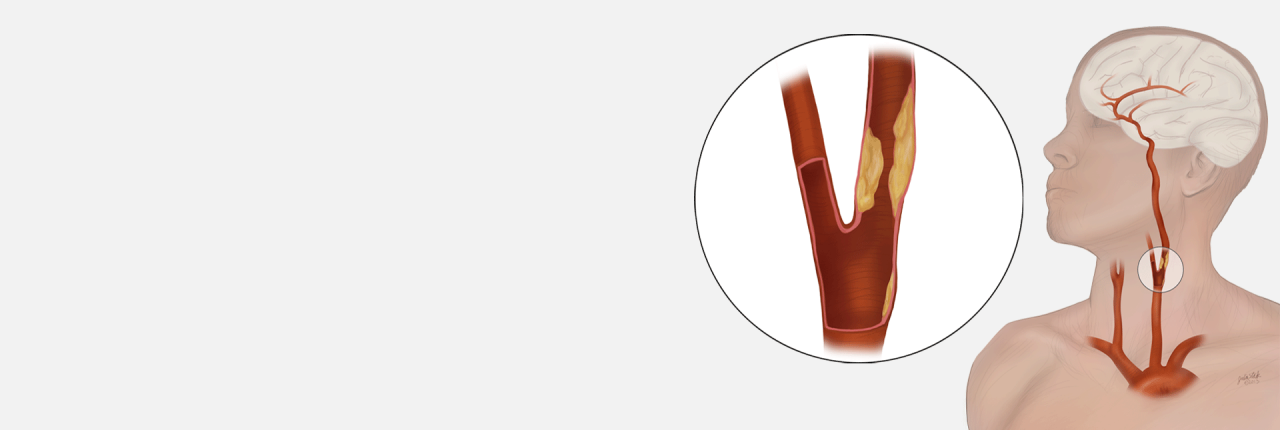  close-up illustration of blockage in carotid artery.