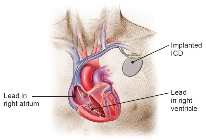 Illustration of chest with heart showing implanted ICD