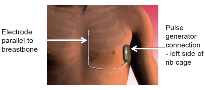 Illustration showing chest with electrode parallel to breastbone and pulse generator connection - left side of rib cage