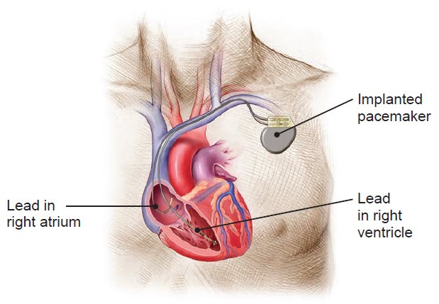 An implanted dual-chamber pacemaker system.