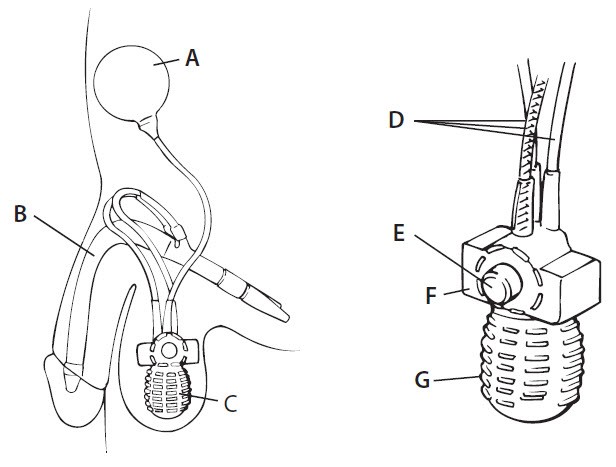 diagram of anatomy with implant showing reservoir, cylinders, pump, tubing, deflation button, deflation block and pump bulb