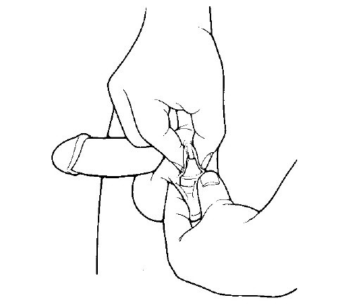Illustration showing how to inflate your implant