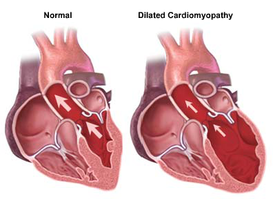 Image of hearts showing a normal and a dilated cardiomyopathy heart