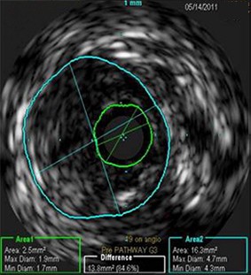 Jetstream Calcium Study: Image 2a (IVUS):Pre-procedure CTO of right distal SFA/proximal popliteal. Baseline IVUS measurement reveals area of 2.5 mm2